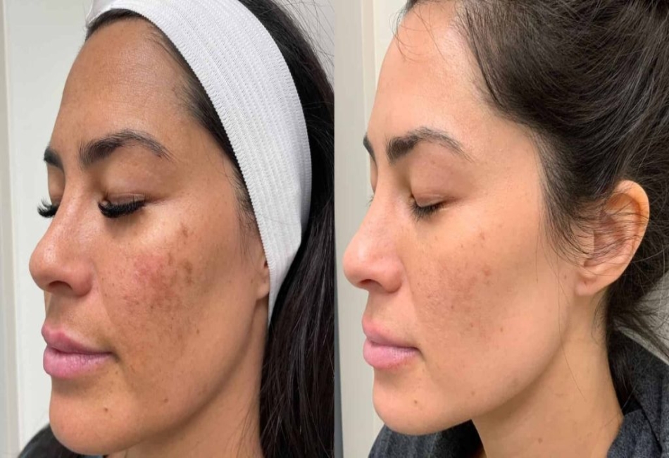 Understanding Melasma: The Complexities and Misconceptions About Treatment