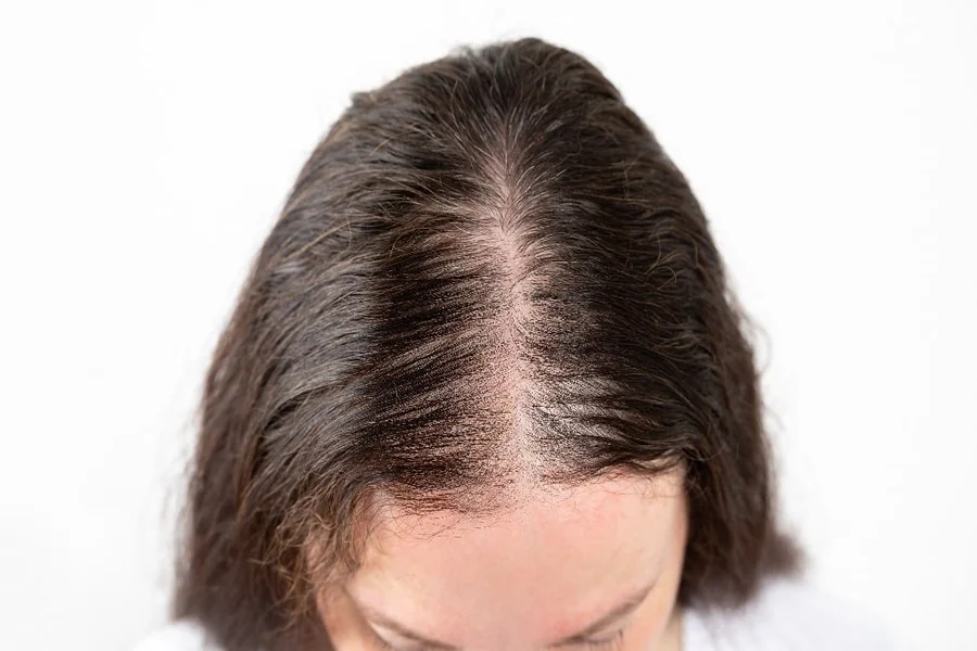 Understanding Hair Loss and the Journey Toward Scalp Health & Confidence