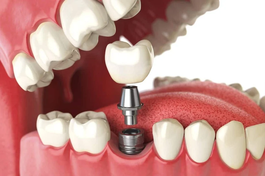 6 Tips For A Smooth Recovery After Dental Implant Surgery