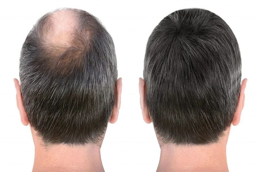 Minoxidil Singapore Side Effects: What Patients Need to Know Before Starting